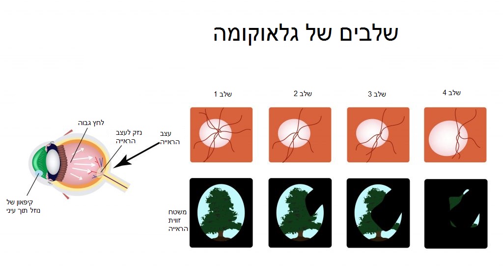 תסמינים גלאוקומה 